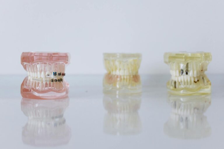 Close-up of dental models displaying braces and dentures for orthodontic education.