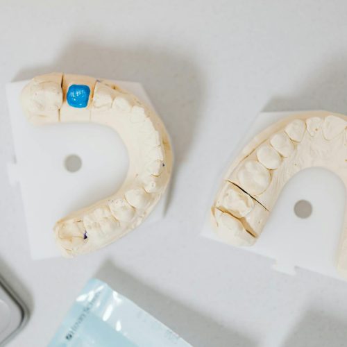 Close-up of dental molds on a white table, showcasing orthodontic details.